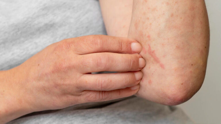 Can You Be Allergic To Strawberries? All You Need To Know