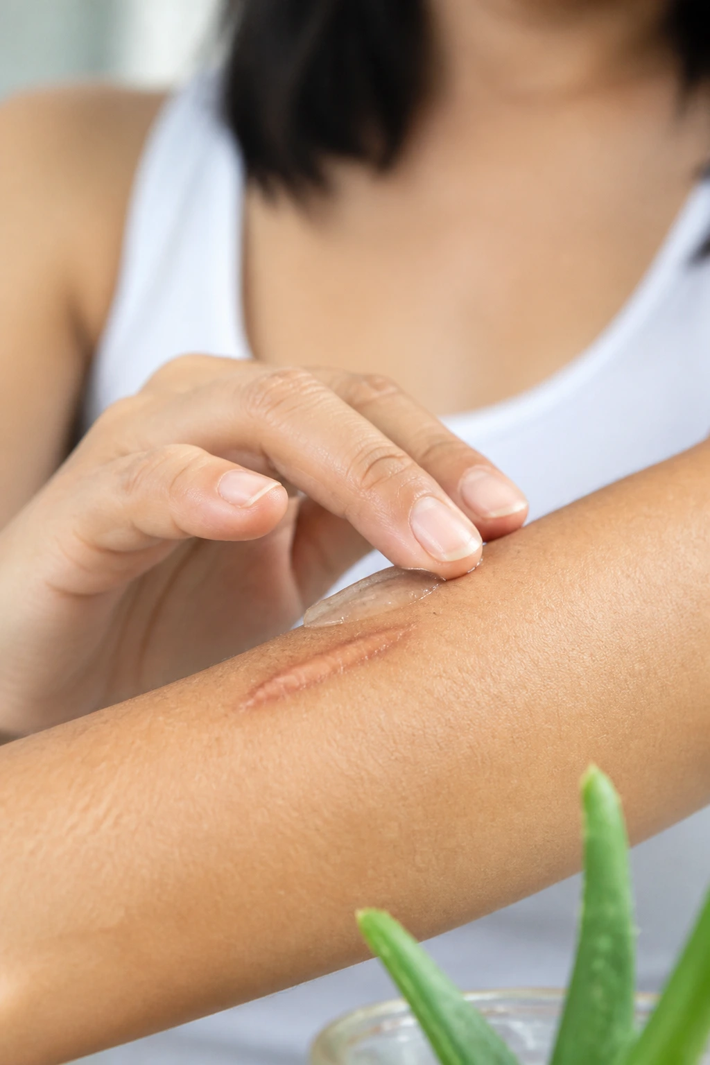Is Coconut Oil Good for Removing Scars on the Body? 3 Aloe Vera gel on scar on forearm